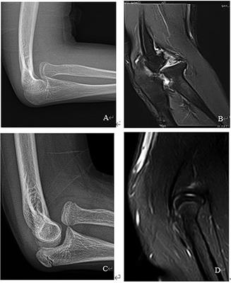 Radiocapitellar joint plasty for missed monteggia fracture with radial head deformity in children: a retrospective study